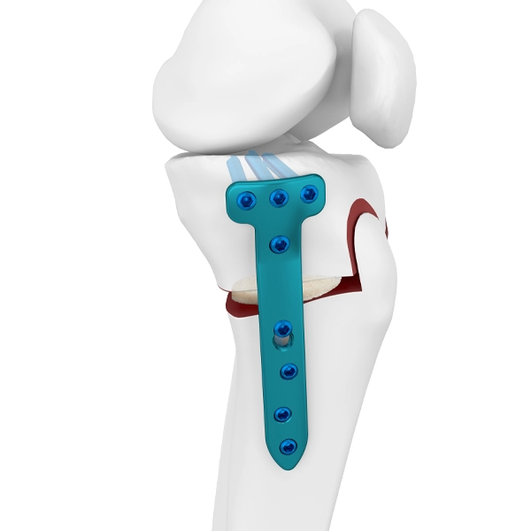 Proksimal Medial Tibial Osteotomi Kilitleme Plakası