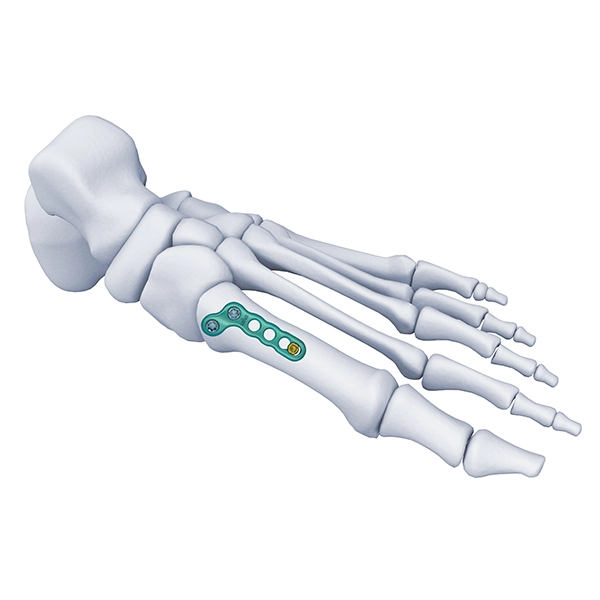 Metatarsal için MT L-Kilitleme Plakası