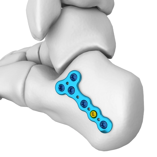 MT Posterior Tuberosity Kalkaneal Kilitli Plak